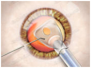 India Intraocular Lenses, IOL, Intraocular Lenses Implantation, India Hospital Tour