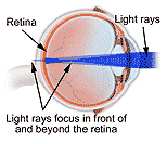 Refractive Errors Surgery, Refractive Errors India, Corrective Eye Surgery, Photorefractive Keratectomy Surgery