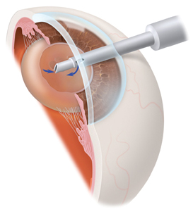 Small Incision Cataract Surgery, Small Incision Cataract Surgery India