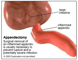 Appendectomy Surgery offers info on Appendectomy Surgery   India, Before An Appendectomy India