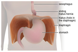 Gastric Hiatus Hernia Surgery offers info on Gastric India, Hiatal Hernia India, Hernias India