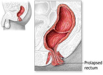 Rectal Prolapse Surgery   India, Full-Thickness Rectal Prolapse India, Rectal Ulcers India, External Prolapse India