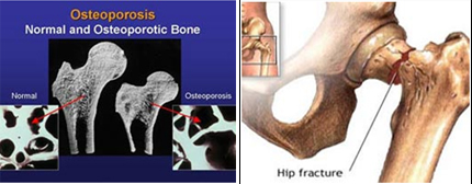 DEXA Scan offers info on Bone Densitometry Osteoporosis Scan India, Bone India