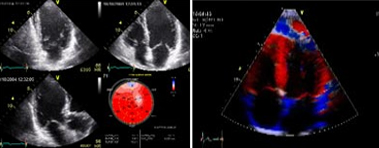 2D Colour Doppler offers info on 2D Echo Color Doppler  India, Echo Doppler  India, 2D Color Doppler India