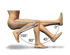High Flex Knee Replacement, High Flex TKR, Flexible, High Flex Knee Replacement Surgery India