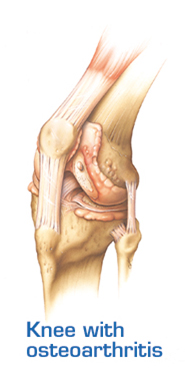 High Flex Knee Replacement, High Flex TKR, Flexible, High Flexion
