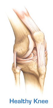 High Flex Knee Replacement Procedure, Flexible, High Flex Knee Replacement Surgery India