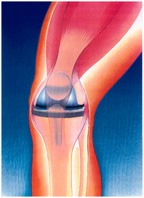 Total Knee Replacement Surgery India, Surgery Activities, Knee Pain