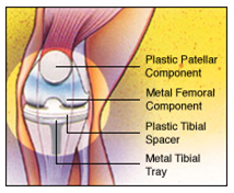 Total Knee Replacement Surgery India, Total Knee Replacement Surgery Risks