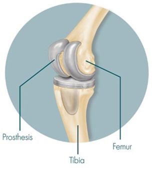 Unilateral Knee Replacement, Unilateral Knee India, Primary Unilateral