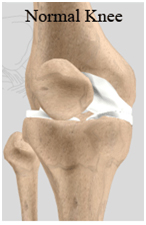 Unicondylar Knee Replacement, Unicondylar Knee Replacement India