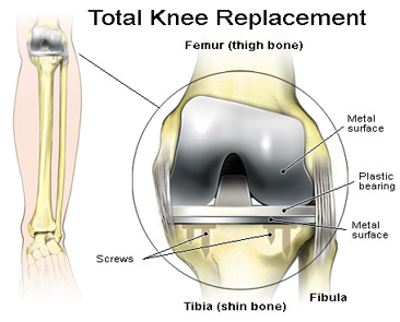Knee Replacement Abroad, Low Cost Knee Replacement India, India Knee Pain