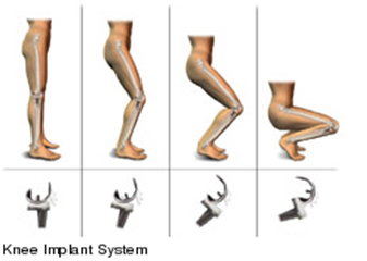Knee Joint Replacement Overseas, Total Knee Implant, Knee Arthritis