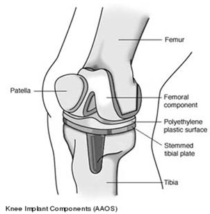 Knee Replacement Implant, Knee Replacement Implant India, Knee Joint Replacement Overseas
