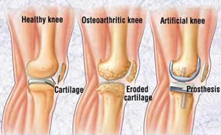 Knee Replacement India,Knee Replacement Surgery India Knee Replacement Surgery
