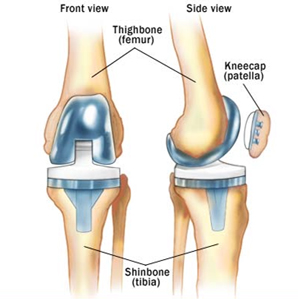 Knee Replacement, Knee, Knee Arthroplasty, Relive Pain