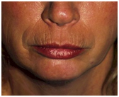Laser Facial Wrinkle Removal Surgery India offers info on Face Tightening Uplift India, Surgical Facelift India
