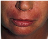 India Face Tightening Uplift India, Surgical Facelift India, White Patch Removal Surgery India