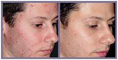 Laser Surgery India Acne Removal offers info on Cost Acne Removal Laser Surgery India, Laser Therapy Reduces Facial Acne India
