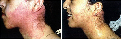 Laser Birthmark Removal Treatment India, Low Cost Laser Birthmark Removal Treatment Mumbai India