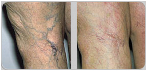 Low Cost Leg Skin Veins Surgery Delhi India, Leg Skin Veins Surgery Mumbai Hospital India