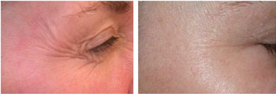 Laser Facial India, Laser Hair Removal India, Laser Treatment India