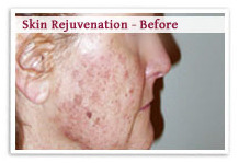 Skin Rejuvenation Laser Surgery India offers info on Laser Skin Rejuvenation India, Laser Facial India, Laser Treatment India