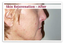 Skin Rejuvenation Laser Surgery India offers info on Laser Skin Rejuvenation India, Laser Hair Removal India