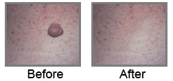 Laser Surgery India Wart Removal offers info on India Wart Removal Surgeons Hospital India, Mole Removal India, Wart Removal India