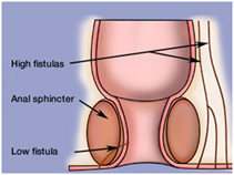 Anal Fistula Surgery India offers info on Low Cost Anal Fistula Surgery In India