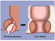 Anal Fistula Surgery India offers info on Low Cost Anal Fistula Surgery In India, Anal Fistula Surgeons India, Piles India