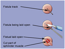 Anal Fistula Surgery India offers info on Low Cost Anal Fistula Surgery In India, Hemorrhoids India, Fissure India, Fistula India