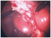 Testimonial Of Gastric Bypass Surgery India, Photos Of Laparoscopic Cholecystectomy Surgery India