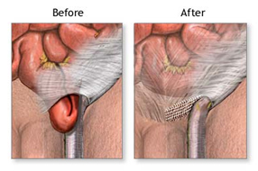 Abdominal Endoscopy India, Band-Aid Surgery India, Bulge In Groin India, Laparoscopic Hernia Repair Surgery Hospital India