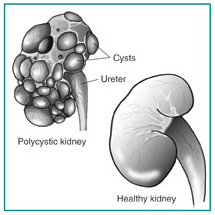 Polycystic Kidney Disorder Treatment India Offers info on Polycystic Kidney Surgery India, Cost Polycystic Kidney Surgery India