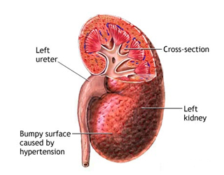 Renal Hypertension Treatment India Offers info on Cost Renal Hypertension Treatment India, Renal Hypertension India