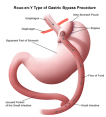 Gastric Bypass Surgery offers info on Bypass Surgery India, Gastric Bypass India, Gastric Bypass Surgery India, India Hospital Tour India