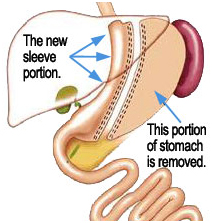 Sleeve Gastrectomy Surgery offers info on Gastrectomy Surgery India, Sleeve Gastrectomy India, Gastrectomy India, Vertical Sleeve Gastrectomy India