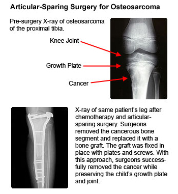 Non Cancerous Tumors Surgery India, Non Cancerous Pancreatic Tumors India, Cancerous Tumors India