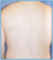 Laser Hair Reduction Treatment offers info on India Laser Hair Removal Advantages India, Laser Hair Removal Advantages India, Laser Hair Reduction India