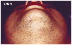 Laser Hair Reduction Treatment offers info on India Laser Hair Removal Advantages India, Hair Reduction India, Hair India