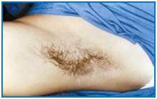 Laser Hair Reduction Treatment offers info on India Laser Hair Removal Advantages India, Hair Reduction India
