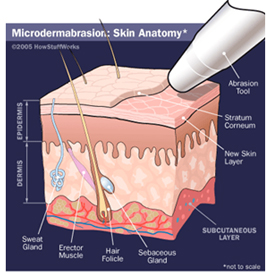 Microdermabrasion Surgery India offers info on Cost Microdermabrasion Surgery India