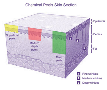 Deep Peel Surgery India offers info on Cost Deep Peel Surgery India, Deep Peel Surgeon India, Chemical peel work India, Chemical Peel Procedure India