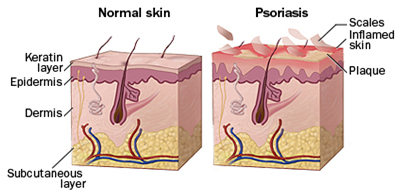 Psoriasis Treatment India offers info on Psoriasis Treatment Hospital India, Stem Cell Therapy Psoriasis India