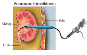 Percutaneous Nephrolithotomy Surgery India offers info on Cost Percutaneous Nephrolithotomy Surgery India