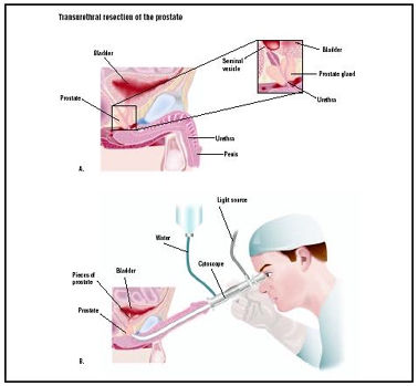 Cost TURP-Transurethral Resection of Prostate Surgery India, TURP-Transurethral Resection of the Prostate surgery India