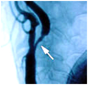 Carotid Artery Disease offers info on Carotid Artery Stenosis India, Carotid Artery Disease Surgery India