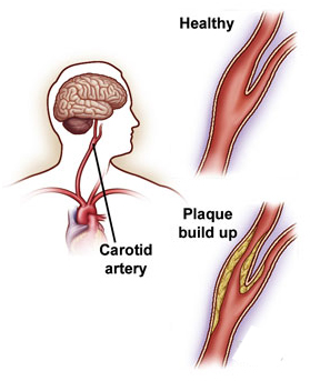 Carotid Artery Disease offers info on Carotid Artery Stenosis India, Atherosclerosis India
