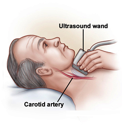 Atherosclerosis India, Carotid Endarterectomy India, Carotid Artery Disease Surgery India